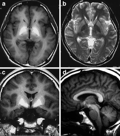 Sự tích tụ mangan trong não: Hình ảnh cộng hưởng từ (MR imaging)